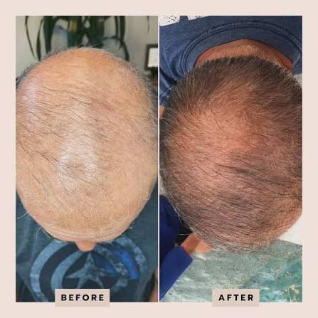 Biohair Restoration