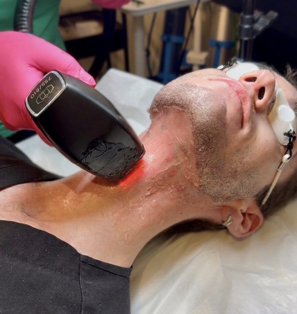 Laser Hair Reduction